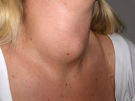 Struma : goitre, nodules et hypertrophie de la thyroïde | Guide de médecine de premier plan