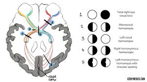 Image result for Visual Field Deficit