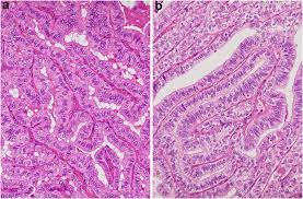 The New 4th Edition World Health Organization Classification For Thyroid Tumors Asian Perspectives Kakudo 2018 Pathology International Wiley Online Library