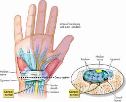 With tendon or fascial graft (includes obtaining graft) separate procedure (26502) flexor tendon excision, implantation of plastic tube or rod for delayed tendon graft, hand or finger (26390) repair, intrinsic muscles of hand (26591) Carpal Tunnel Syndrome Www Medicoapps Org