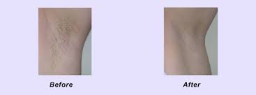 But, if you are somewhere in the middle we will cover that at the consultation. Laser Hair Removal Portland Oregon Pain Free Hair Removal