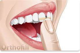 You will also get the solutions of your answers. Home Orthofill Gap Teeth Fix Teeth Teeth Straightening