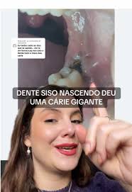Como Evitar Cáries em Dentes Siso