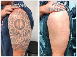 Laser Tattoo Removal Before And After Update 2021 Laser Tattoo Tattoo Removal Laser Tattoo Removal Before And After