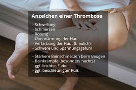 Oft sind die beinvenen betroffen. Welche Anzeichen Deuten Auf Eine Thrombose Hin