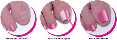 Compared with shopping in real stores, purchasing products including nail art on dhgate will endow. Cosmetic Answer For Toenail Loss Cleveland Com