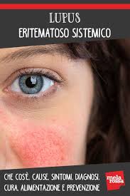 Spiegheremo le cause e le complicanze della malattia autoimmune e come si può trovare la giusta opzione di trattamento. Lupus Eritematoso Sistemico Cause Sintomi Diagnosi Cura E Prevenzione Lupus Malattia Autoimmune Rimedi Per La Salute