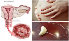 Aviacija Dabar Nuodėmė Yeast Infection During Pregnancy First Trimester Yenanchen Com