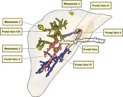 Right lobe of liver anatomy, diagram & function | body maps the liver is divided into two lobes by the middle hepatic vein: A Labeling Of The Portal Vein And Metastases Located Inside The Download Scientific Diagram