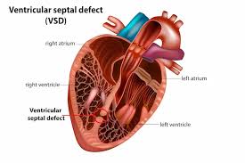 Image result for Ventricular Septal Defect