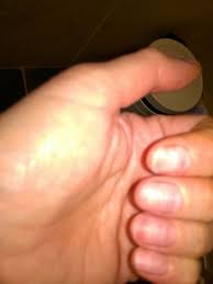 Many women who wear artificial acrylic nails and hope to return to natural nails are. Remedies For Nail Pain After Removing Acrylic Nails Thriftyfun