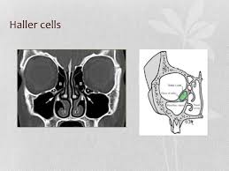 Haller cells are one of the anatomical variations in the orbital area, which are important in endoscopic surgical procedures and have a role in the pathogenesis of some diseases. Radiology Of Nasal Cavity And Paranasal Sinuses Ppt Download