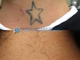 Thomas adrian and his staff at the center for laser surgery. Tattoo Removal Washington Dc Center For Laser Surgery