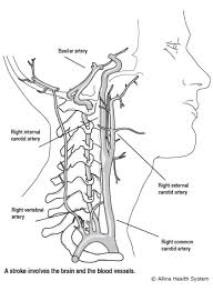 The carotid system of arteries and the jugular system of veins. Understanding Stroke Causes And Types Of Strokes