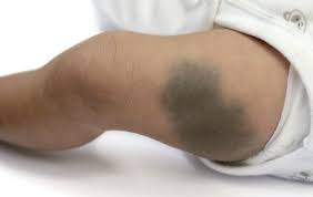 Birthmark On Leg Meaning In Hindi Birthmarks On Legs Meaning Of Christmas Henwds Travelchristmas2020 Info