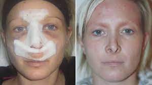We talk to a woman who had a nose job to find out what it's really like to get plastic surgery. My Doctor Flew Off When Cosmetic Surgery Went Wrong Bbc News