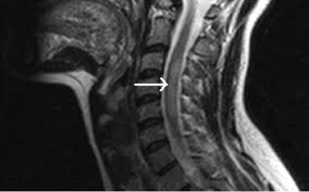 Image result for Myelitis