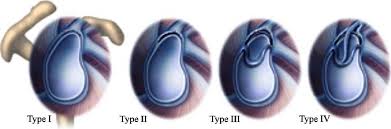 Image result for SLAP Lesion