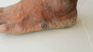 Image result for brown patches on the feet