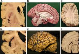 Neuropathological Comparison Of Adult Onset And Juvenile Huntington S Disease With Cerebellar Atrophy A Report Of A Father And Son Abstract Europe Pmc