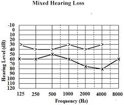 Classification Of Hearing Loss Intechopen