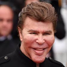 He had the eyelid/brow combo surgery 😅