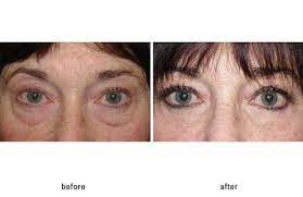 Natural Lower Blepharoplasty Results Eye Surgery Eye Lift Restylane