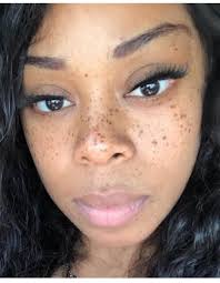 Introduction of precious aka freckles