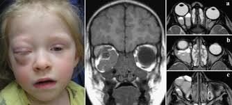 Exophthalmos , also spelled exophthalmus , also called proptosis , abnormal protrusion of one or both eyeballs. Retrobulbare Raumforderung Bei Einem Kleinkind Mit Akutem Exophthalmus Springerlink