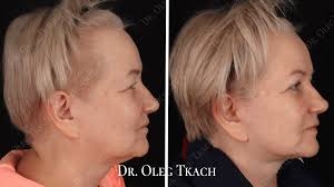 Результати операцій на обличчі