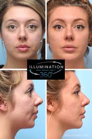 Cheek fillers have always been there. Facial Dermal Fillers Before After Click Into The Link And Get More Info About Her Treatment Treated Area Lip Fillers Under Eye Fillers Blusher Makeup