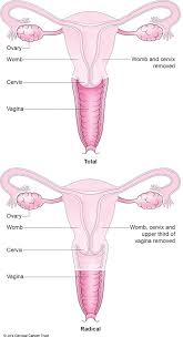 It's been a very long journey and had lots of different treatments. Having A Hysterectomy Jo S Cervical Cancer Trust