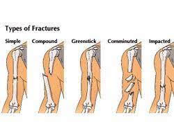 Types Of Fractures Types Of Fractures Perioperative Nursing Medical Knowledge
