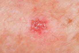 Image result for infected tick bite