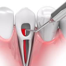 What causes the need for root canal treatment? Help Decide Between Extractions And Root Canal Crowns
