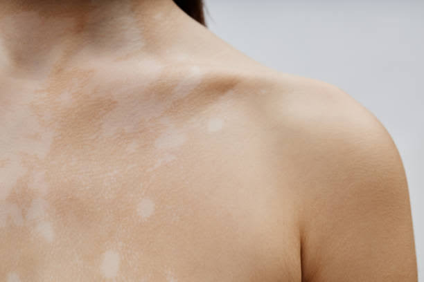 White Patches on Skin Australia: Common Causes Explained - Australian  Psoriasis and Eczema Supplies