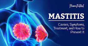 How long do periods last: Mastitis Causes Symptoms Treatment And How To Prevent It