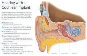 What is a cochlear implant, how does it work, whom is it for and what is the succes rate? Cochlear Implants Auditory Implant Service