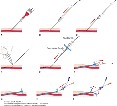 Peripheral Inserted Central Catheter Picc Lines