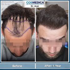 Garant hair transplant ist die beste haartransplantationsklinik in der türkei. Haartransplantation Dr Levent Acar Cosmedica Istanbul Facebook