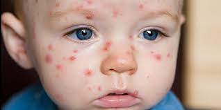 Learn about chickenpox (chicken pox) signs, symptoms, causes, and treatment for this highly contagious viral infection. Petua Menghilangkan Parut Chicken Pox Cara Tradisional