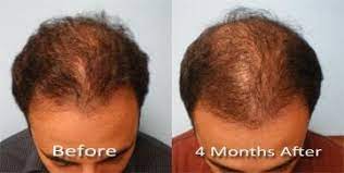 During hair transplant surgery of any kind. Shock Loss After Hair Transplant Concerns Parsa Mohebi Hair Restoration