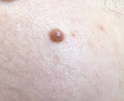 Image result for Spitz Nevus