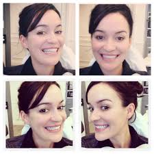 Double Jaw Surgery Jaw Surgery Double Jaw Surgery Orthognathic Surgery
