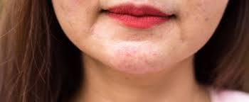 Eczema is a condition that causes inflamed, itchy, cracked, and rough skin. Was Ist Eine Periorale Dermatitis Und Wie Wird Sie Behandelt