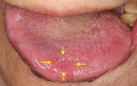Image result for cancer tongue symptoms)