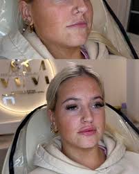 Loving all these lips lately — 1.1ml lip augmentation carried out to  increase volume and enhance definition. Focus