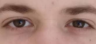 Linkes Auge Schwellung Kleiner Eventuell Entropium Gesundheit Und Medizin Augen Schonheit