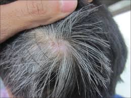 This process happens with hair all over the body, including pubic hair. Indian Journal Of Dermatology Venereology And Leprology Premature Graying Of Hair