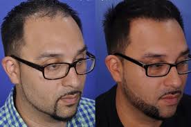 FUE Hair Restoration — PēkoMD: Dr. Daniel Straka